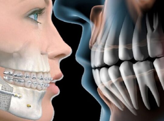 İmplant Diş Fiyatları